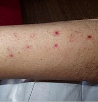 Numerous spots of bleeding into the skin of the leg in a person infected with T. b. rhodesiense[14]