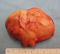 The resected lipoma (8 cm × 6 cm × 3 cm)