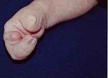 colour photograph of a hand of a patient with Limb–mammary syndrome. Two out of 3 fingers are present with 2 fingers fused
