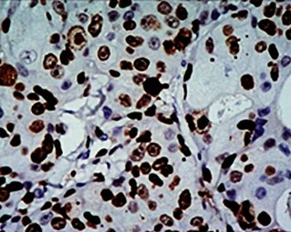 High Ki-67 expression in an invasive breast cancer, with cancer nuclei being stained (brown). There is tumor cell positivity in 70% of the cells: Ki-67 labelling index = 70%