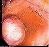 A polyp in the small bowel