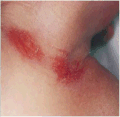 Abrasion from a nuchal cord
