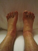 Edema of both legs after walking more than 100 kilometers.