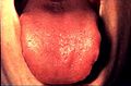 TONGUE: (Figure 8) With the patient's tongue at rest, and mouth partially open, inspect the dorsum of the tongue for any swelling, ulceration, coating, or variation in size, color, or texture. Also note any change in the pattern of the papillae covering the surface of the tongue and examine the tip of the tongue. The patient should then protrude the tongue, and the examiner should note any abnormality of mobility or positioning.
