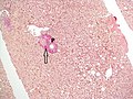 No fibrosis, but mild zone 3 steatosis, in which collagen fibres (pink–red, arrow) are confined to portal tracts (P) (Van Gieson's stain)[92]