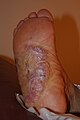 Keloid in the sole of foot in a patient with large keloids elsewhere