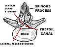 Thumbnail for Spinal stenosis