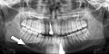 Panoramic radiograph of a simple mandible fracture of the right mandibular body, minimally displaced. Note that the teeth to the left of the fracture do not touch