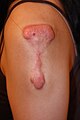 Flat, superficially spreading keloid in upper arm area
