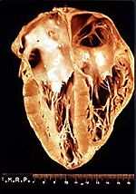 Photograph of a heart showing perforation of the walls