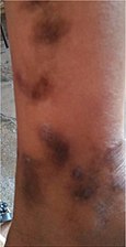 Secondary yaws scars in an adult with childhood history of yaws
