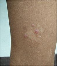 Secondary yaws begin as multiple small lesions.