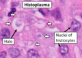 Histopathology of Histoplasma capsulatum, H&E stain, showing organisms surrounded by halos, in a granuloma of epithelioid histiocytes.