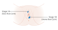Stage 1A and 1B vulvar cancer