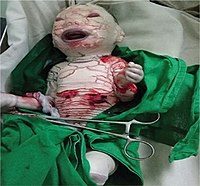 Harlequin ichthyosis in a male infant