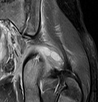 Coronal T2 weighted fat suppressed image showing a multiloculated fluid collection in the left gluteal musculature due to tropical pyomositis in a 12-year-old boy.