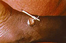 White worm emerging from a blister on a person's leg, coiled around a matchstick
