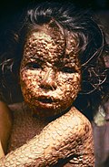 Child with smallpox, 1973