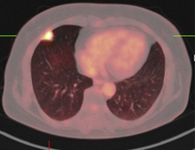 PET-CT of a tuberculoma