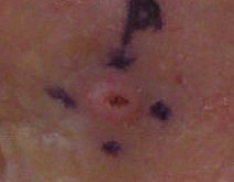 SCC, left lateral canthus marked for biopsy