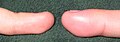 Left and right ring fingers of the same person: The distal phalanx of the finger on the right exhibits swelling due to acute paronychia.