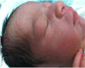 Petechiae on face due to tight nuchal cord