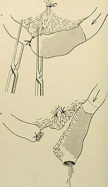 Illustration of resection of bowel segment as performed in the early 1900s.