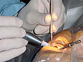 Thumbnail for Cataract surgery
