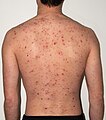 The back of a 30-year-old male after five days of the rash