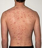 Chickenpox rash in an adult male