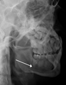 lateral oblique image demonstrating a fractured mandible.