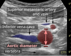 Compression is used in this ultrasonograph to get closer to the abdominal aorta, making the superior mesenteric vein and the inferior vena cava look rather flat.