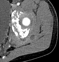 CT exam showing a multiloculated fluid collection in the left gluteus minimus muscle found to be a staph aureus pyomyositis in a 12-year-old healthy boy.