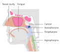 Stage T1 nasopharyngeal cancer