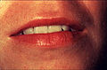 LIPS: (Figure 2) Begin examination by observing the lips with the patient's mouth both closed and open. Note the color, texture and any surface abnormalities of the upper and lower vermilion borders.