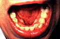 FLOOR: (Figure 12) With the tongue still elevated, inspect the floor of the mouth for changes in color, texture, swellings, or other surface abnormalities.
