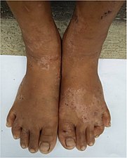 Secondary yaws; hypopigmented areas of skin topped with pink and brown papules, 9-year-old