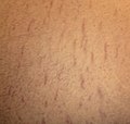 Thumbnail for Stretch marks