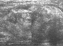 Ultrasonography of a liposarcoma for comparison: In this case a heterogeneous mass consisting of an upper hyperechoic portion, corresponding to lipomatous matrix, and areas of hypoechogenicity corresponding to nonlipomatous components.[24]