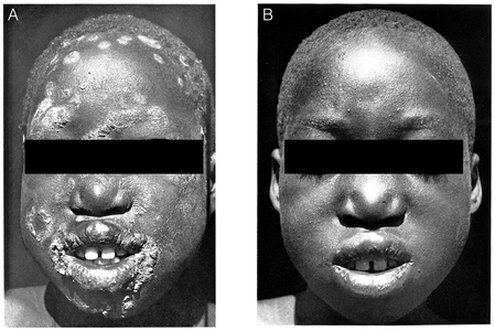 Before and two weeks after a single injection of benzathine penicillin, 1950s.