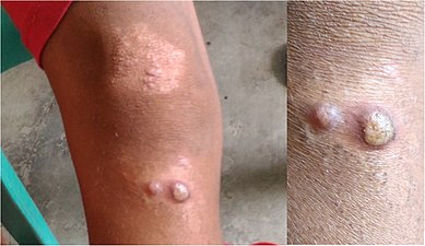Here two different appearances (papulosquamous plaque and yellow-crusted nodules) are seen in the same 10-year-old (large-scale of both, close-up of nodules)