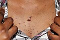 Small size keloid papules