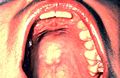 PALATE: (Figures 13 and 14) With the mouth wide open and the patient's head tilted back, gently depress the base of the tongue with a mouth mirror. First inspect the hard and then the soft palate.