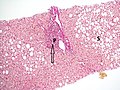 Histopathology of steatohepatitis with mild fibrosis in the form of fibrous expansion (Van Gieson's stain)[92]