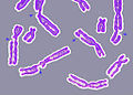 DNA damage resulting in multiple broken chromosomes