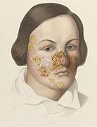 Illustration of a woman with a severe facial impetigo