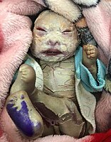 An infant with Harlequin ichthyosis.