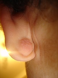 Epidermal cyst in the earlobe