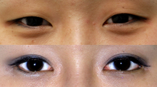 Example of Korean double eyelid surgery