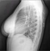 X-ray showing lipoma
